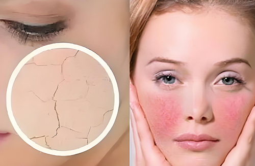 角質層變薄的表現 角質層變薄還能恢復嗎?角質層變薄怎么恢復?