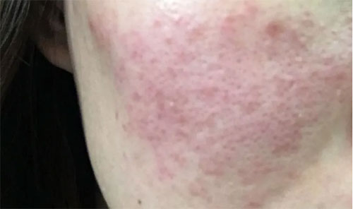 皮膚泛紅 皮膚泛紅癢是什么原因?皮膚紅癢怎么回事?
