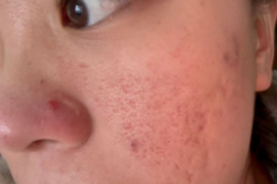 去痘印 去痘印做什么醫(yī)美項(xiàng)目最好?