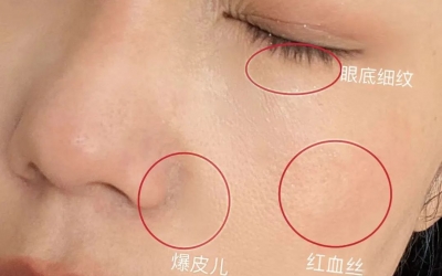 如何判斷自己是不是干敏肌膚？干敏肌有哪些特征？