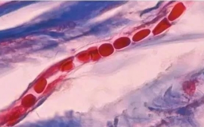 紅血絲是什么原因導致的？紅血絲形成的原因！