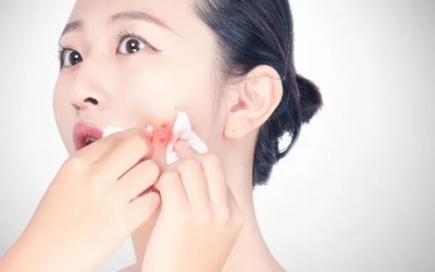 如何預防粉刺的發生和痤瘡的形成？