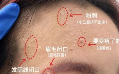 臉上經常長閉口粉刺的原因有哪些？