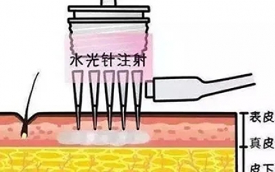 水光針的類型有哪幾種？