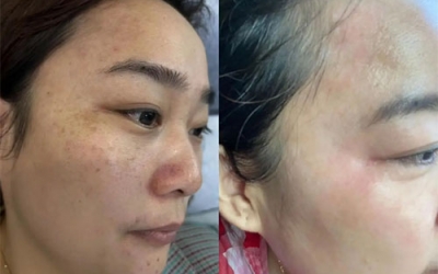 祛斑最好的土方法有哪些？