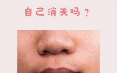 什么是黑頭？怎樣預防黑頭的形成？