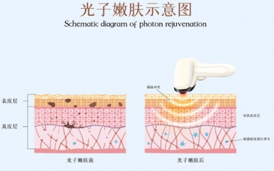 光子嫩膚術前注意事項有哪些？