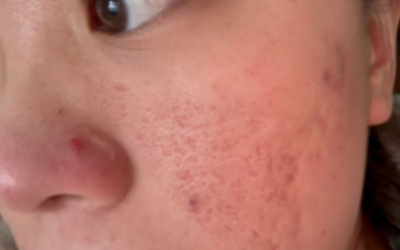 去痘印做什么醫(yī)美項目最好？