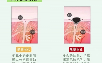 毛孔堵塞怎么疏通毛孔？