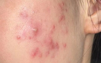 油痘肌和油敏肌怎么區(qū)分？油痘肌和油敏肌的區(qū)別！